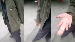 Guy suffers odd condition that gives him a HUGE MIDDLE FINGER